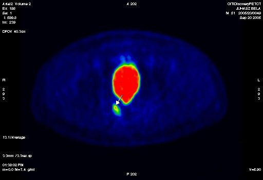 Secondly: CT angiography-anatomy for surgical intervention 41 42 18 F-FDG PET-CT előnyei a