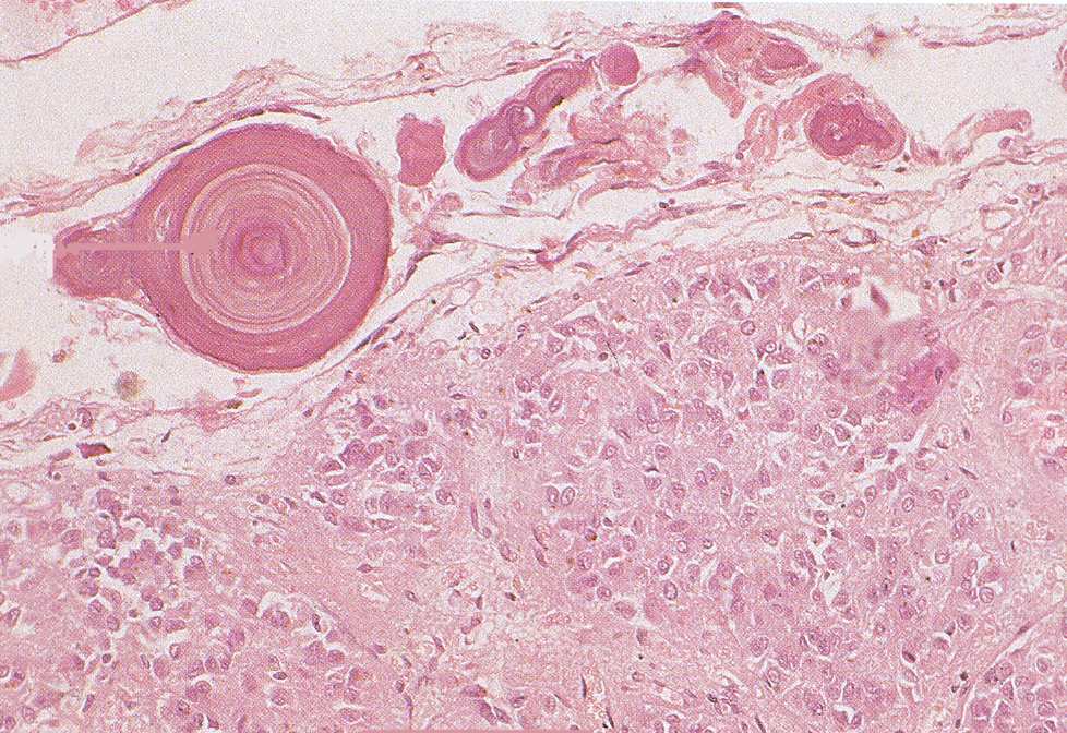 Tobozmirigy corpus pineale, epiphysis cerebri thalamus thalamus tobozmirigy habenulák ACERVULUS CEREBRI - agyhomok Ca ++ ++ Mg ++ hypothalamus Szövettanilag: fejtetıszem 1.