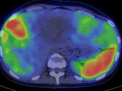 Grade 2 neuroendokrin tumor mpx