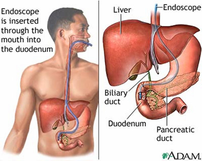 2.1. Akut hasnyálmirigy gyulladás Atlantai Klasszifikáció szerinti 2 forma Intesticiális, heveny, enyhe pancreatitis: A pancreas steril gyulladása, jellemzően intersticiális ödémaképződéssel