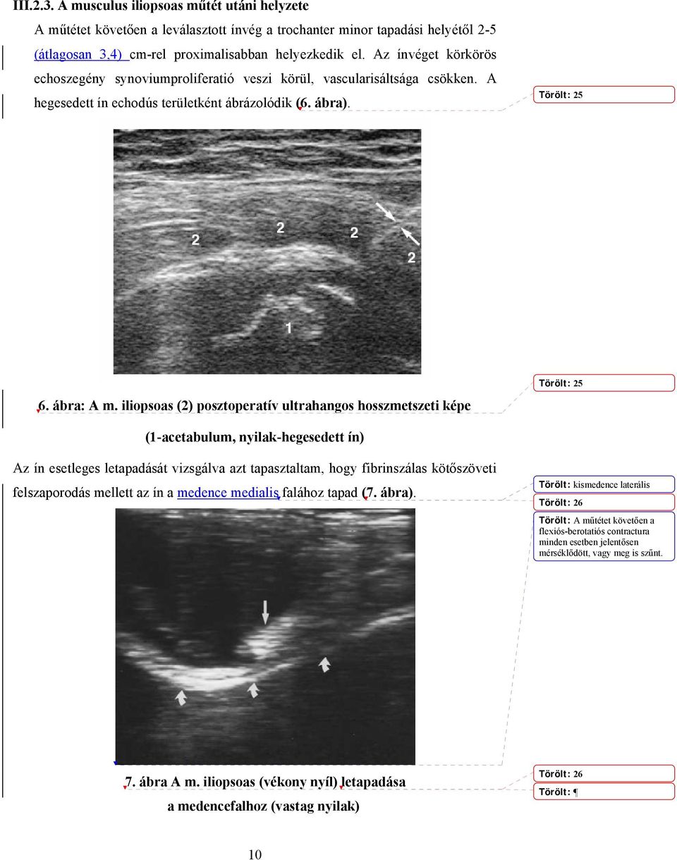 iliopsoas (2) posztoperatív ultrahangos hosszmetszeti képe Törölt: 25 (1-acetabulum, nyilak-hegesedett ín) Az ín esetleges letapadását vizsgálva azt tapasztaltam, hogy fibrinszálas kötőszöveti