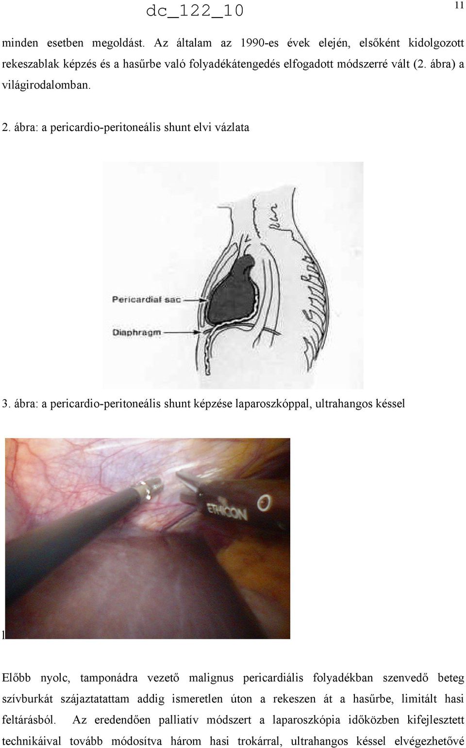ábra: a pericardio-peritoneális shunt képzése laparoszkóppal, ultrahangos késsel l Előbb nyolc, tamponádra vezető malignus pericardiális folyadékban szenvedő beteg
