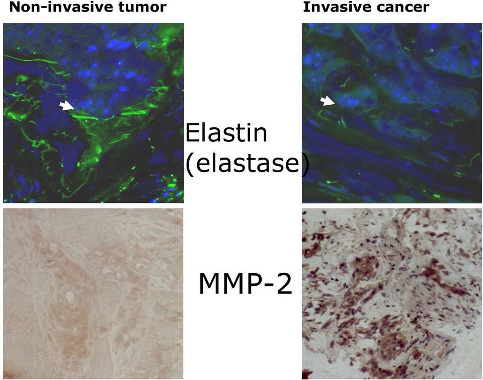 cancer Elastin