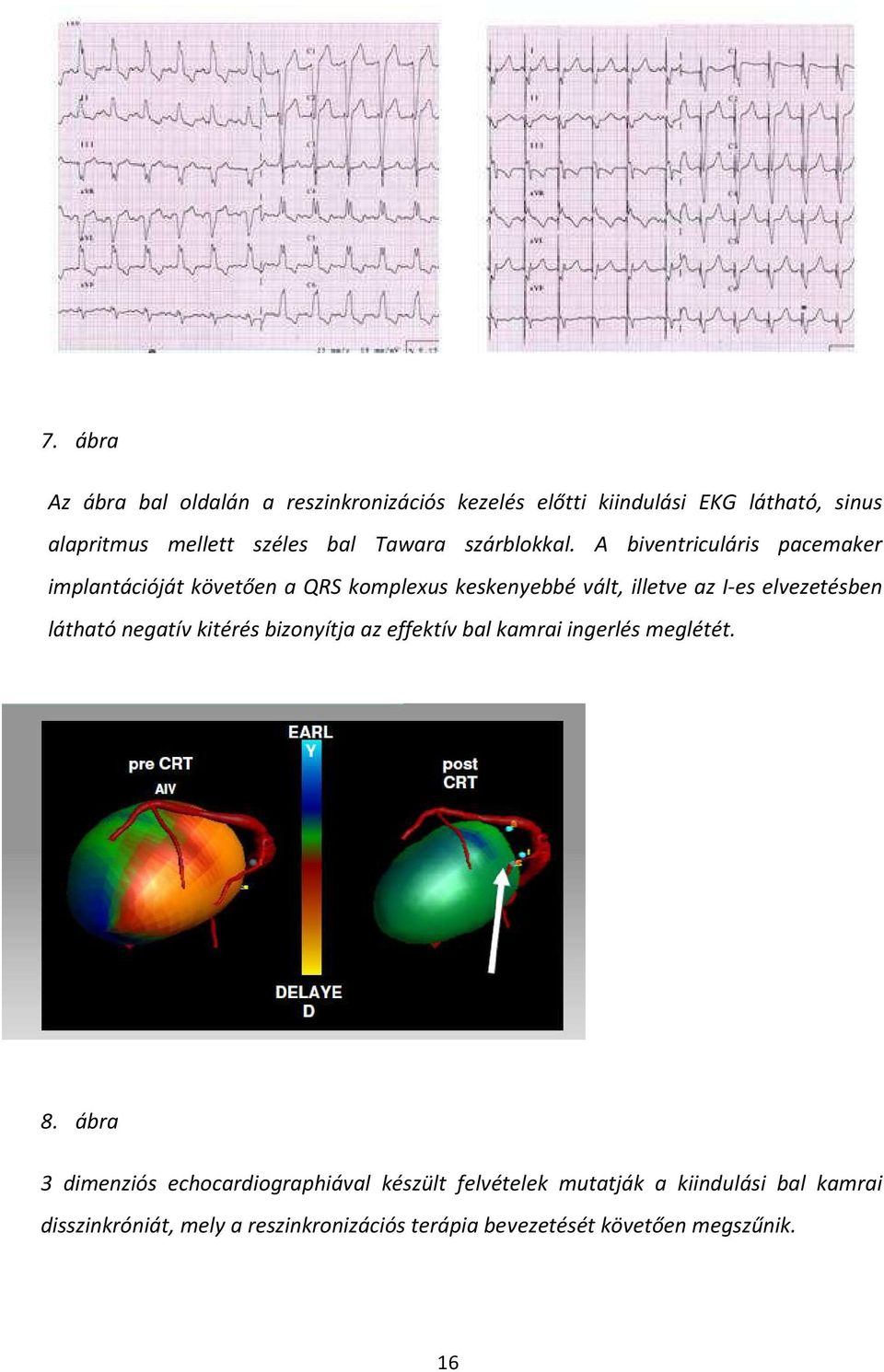 A biventriculáris pacemaker implantációját követően a QRS komplexus keskenyebbé vált, illetve az I-es elvezetésben látható