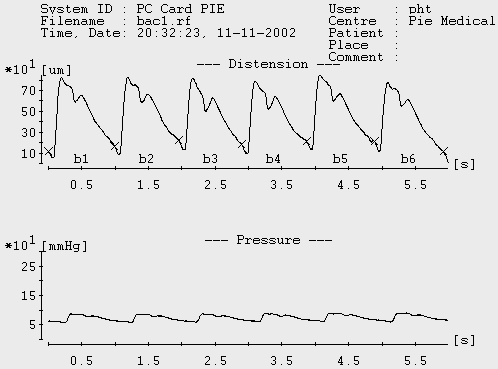 9. ábra: A Wall-Track System számítógépes képernyője. Felül a mérési periódus alatt mintavételezett és tárolt ultrahanghullámok alapján kereszt-korrelációs algoritmussal meghatározott a.