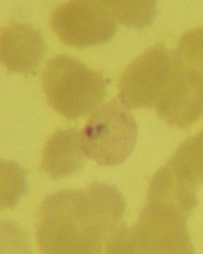 Plasmodium vivax A parazitát tartalmazó vörösvértestek jellegzetesen megnagyobbodnak, halványodnak, és bennük élénken festődő Schüffner-szemcsék jelennek meg (OEK Parazitológiai osztály). II.