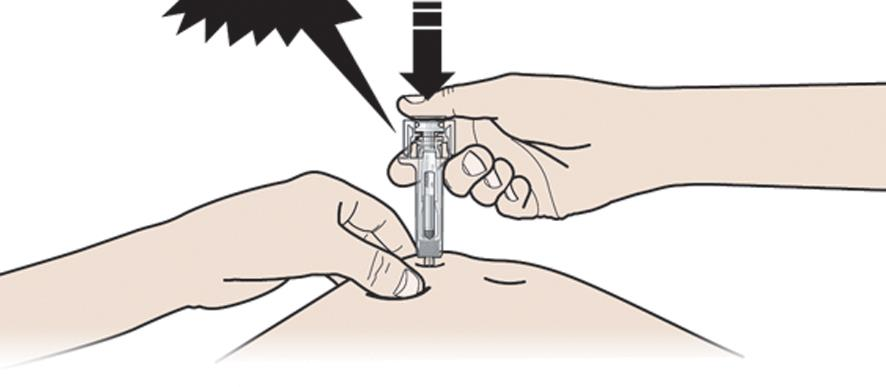 A 3. lépés: Adja be Továbbra is tartsa bőrét összeszorítva. SZÚRJA BE a tűt a bőrbe. Ne érintse meg a megtisztított bőrterületet.