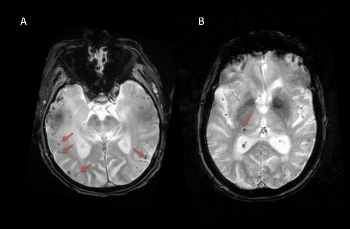 Mikrovérzések Martinez-Ramirez et al.