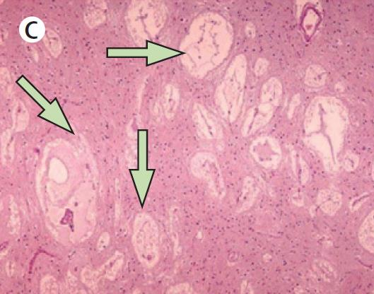 A CADASIL diagnózisa és neuropathológiája Lacunáris (szubkortikális) infarktusok Agyi kisrébetegségek 2016. december 1.