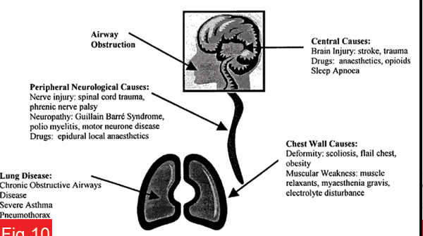 Respiratorikus acidózis Oka: Gázcsere rendellenességek (pl. tüdő betegségek) Fokozott CO 2 termelődés aerob metabolizmus révén. Légúti elzáródás Idegsérülések.