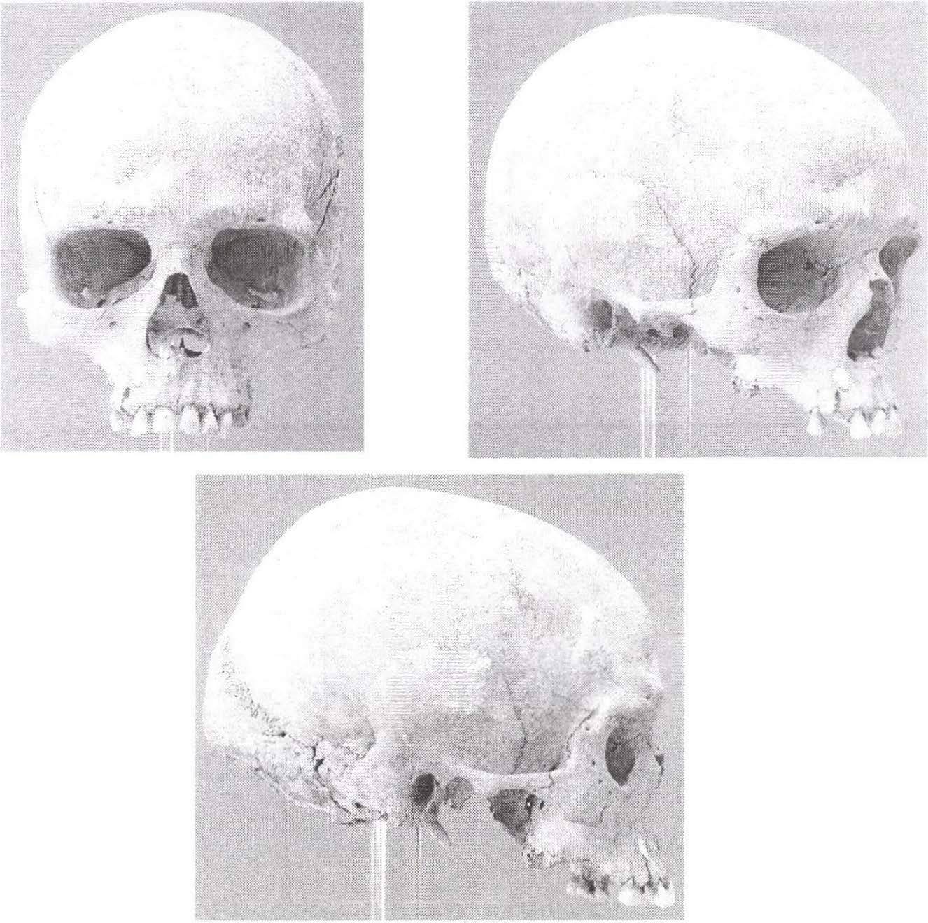 2 ábra: A 18-as sírban fekvő női csontváz koponyája elölnézetből, félprofilból és oldalról. Figure2: Female skull from grave No. 18. Frontal, semi-profile and lateral points of view.