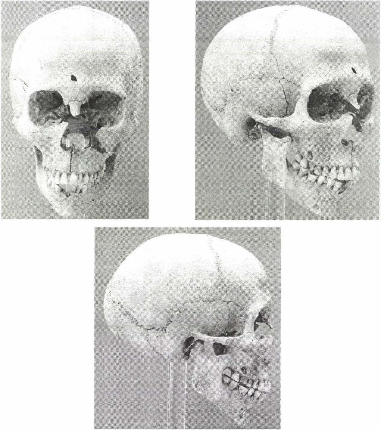 3. ábra: A7-es sírban fekvő női csontváz koponyája elölnézetből, félprofilból és oldalról. Figure 3: Female skull from grave No. 7. Frontal, semi-profile and lateral points of view.