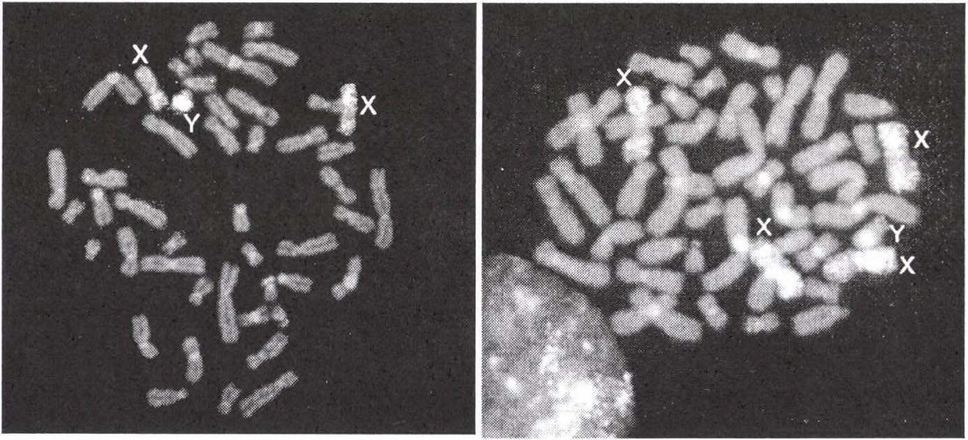 The aim of our study was to identify chromosomal abnormalities, mainly the Klinefelter-syndrome, in infertile men prior to medicine treatment or surgery.