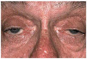 Myasthenia gravis típusos (kezdeti) tünetei: oculopharingealis tünetek Szemtünetek: 90% Ptosis + ophthalmoplegia Nyelészavar,