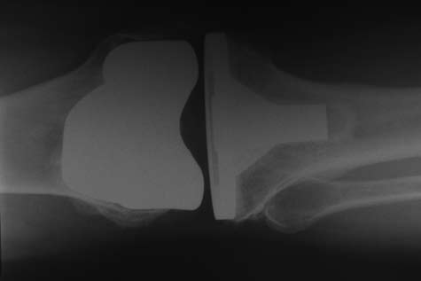 2012/1 OSTEOLOGIAI KÖZLEMÉNYEK 13 A mozgásszervi megbetegedések egyik legfrekventál tabb formája a medialis femorotibialis ízület (MFT) degeneratív elváltozása.