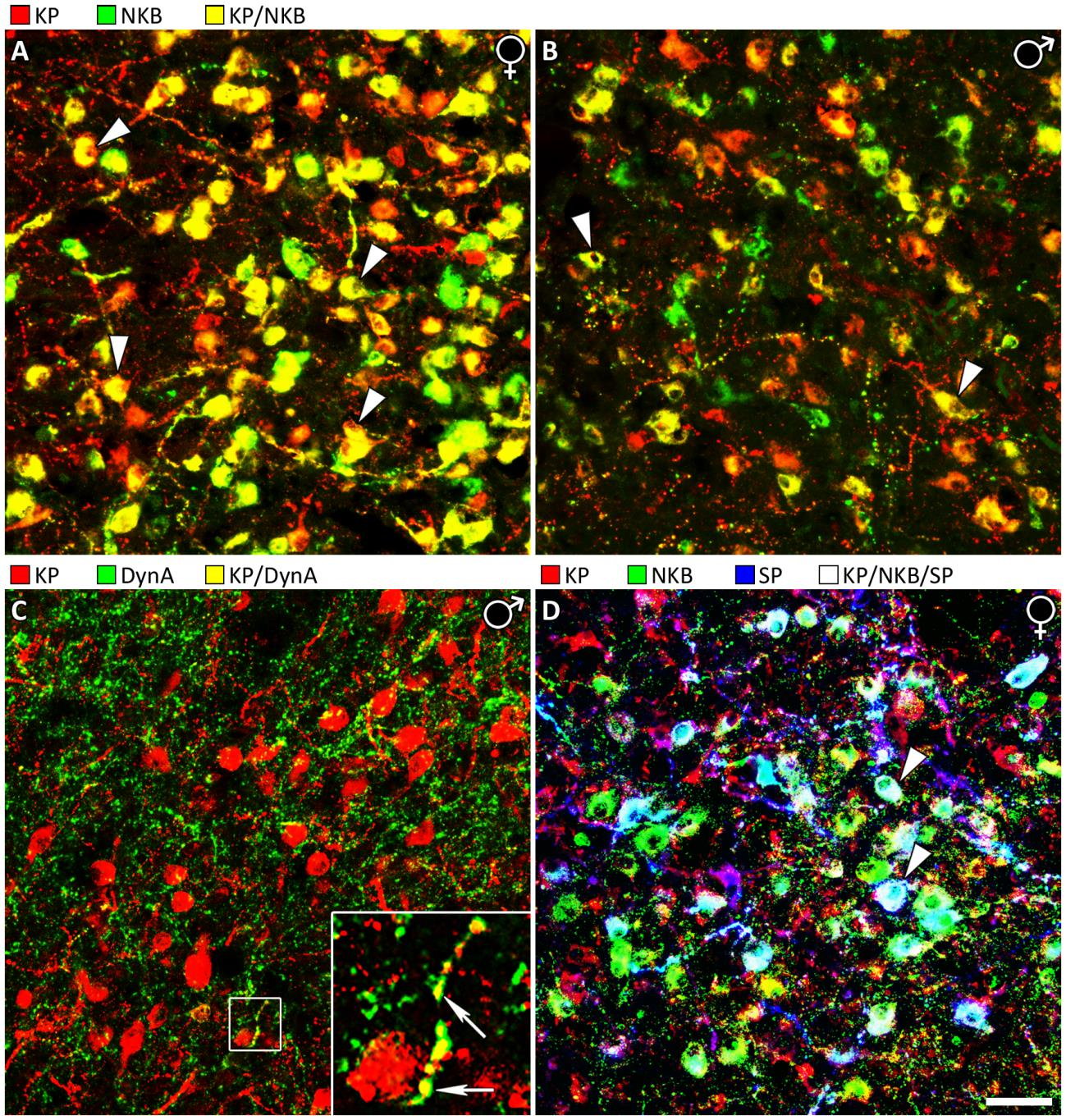 3. ábra: Az emberi hipotalamusz infundibuláris régiójában elhelyezkedő kisspeptin neuronok neuropeptid-fenotípusa.