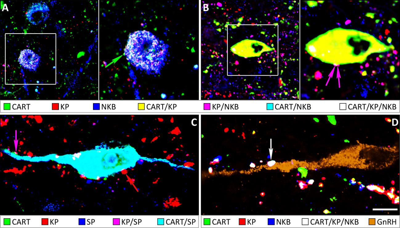 11. ábra: A CART-IR KP, NKB és SP neuronok közötti kapcsolatok morfológiai vizsgálata az infundibuláris régióban. Az CART-IR KP és/vagy NKB és/vagy SP neuronok (színkódot ld.