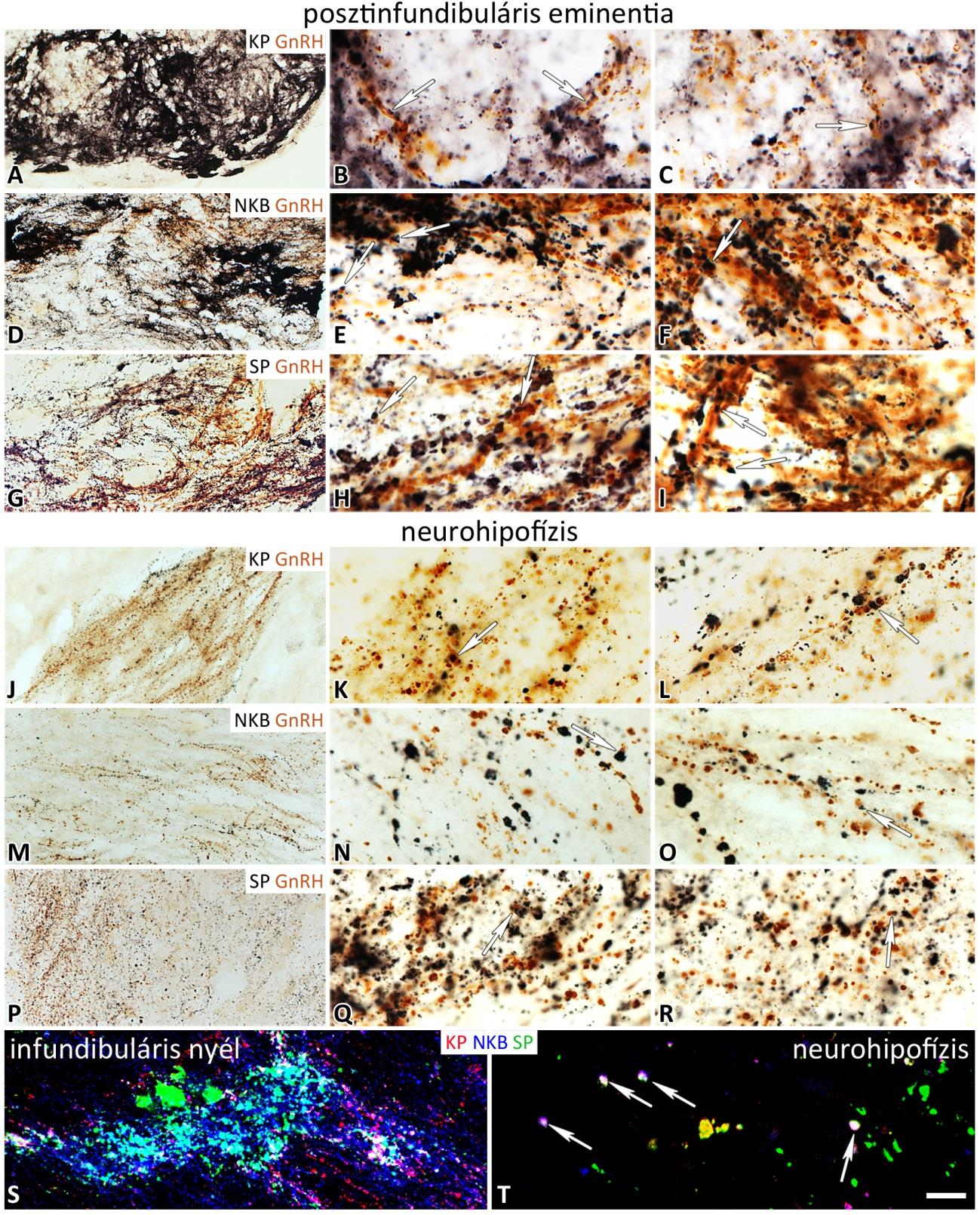 14. ábra: A GnRH-IR, KP-IR, NKB-IR és SP-IR axonok megoszlása a posztinfundibuláris eminentia, az infundibuláris nyél, valamint a neurohipofízis területén.