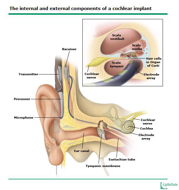 Cochlearis implantátum A közép- és belsőfülbe beépített elektronikus eszköz, melynek célja a belsőfül