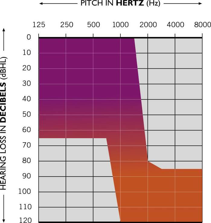 Elektroakusztikus stimuláció Technológiai és műtéttechnikai fejlődés indikációs kritériumok bővültek (ski-slope audiogram) 1999, von Ilberg A cochlea nem működő magas frekvenciájú területeit