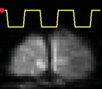 MRI: képi információ manipulálása I MRI: Non-invazív angiográfia Újraszeletelés merőleges síkban képszelet telített spinek véráram telítetlen spinek Térbeli projekció ( volume rendering ) MRI