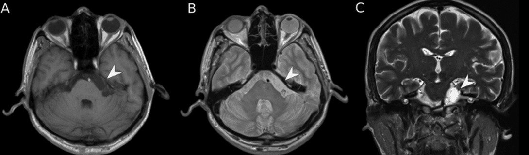 horvath_uj ISZ TUKOR ALAP.qxd 2015.09.14. 14:50 Page 349 Material and methods PATIENTS Two patients with the suspicion of intracranial EC underwent MRI before surgery.