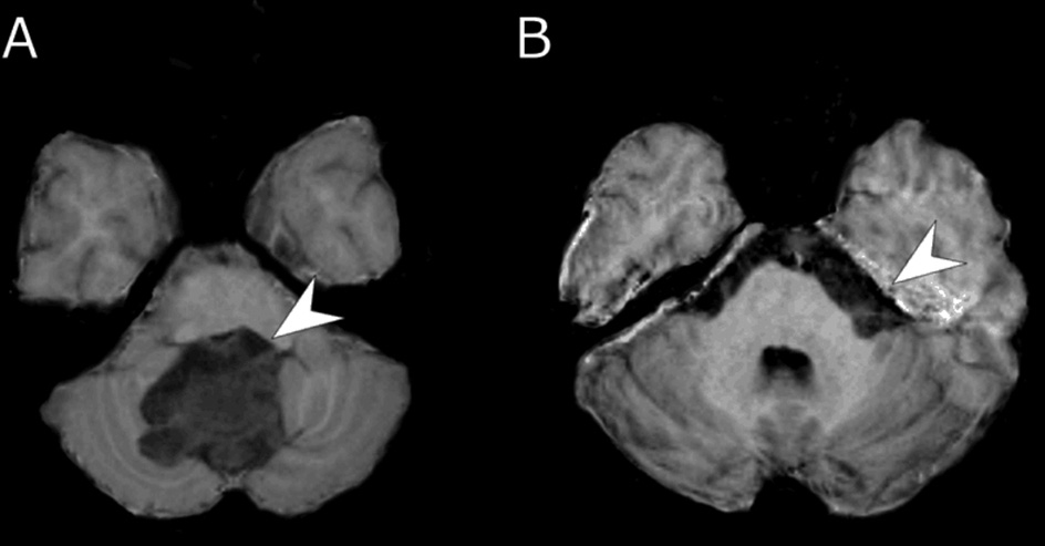 horvath_uj ISZ TUKOR ALAP.qxd 2015.09.14. 14:50 Page 351 Figure 4. DWI of patient 1. DWI with b=0 (A) and ADC map (B) Figure 5. HASTE DWI. Axial (A) and coronal (B) HASTE-DW images of patient 1.