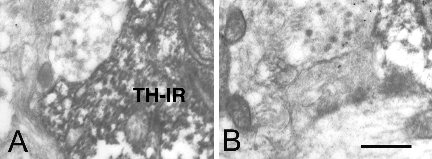 6. ábra. Tirozin hidroxiláz immunoreaktiv neuronon végződő nem GABAerg (A) és GABAerg (B) axo-szomatikus szinapszisok ovariektomizált + 17β-ösztradiollal kezelt patkány nucleus arcuatusában.