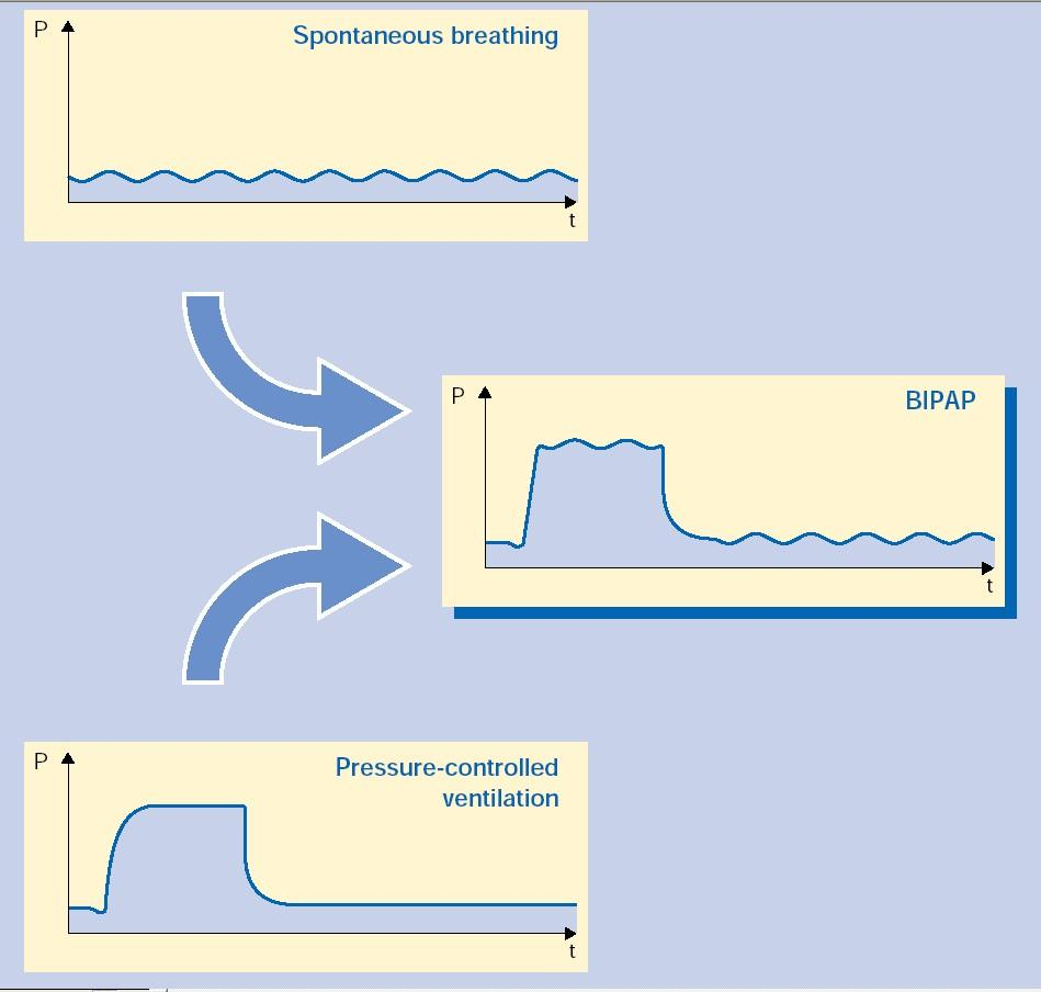 BIPAP, DuoPAP, BiLevel, BiVent nyitott