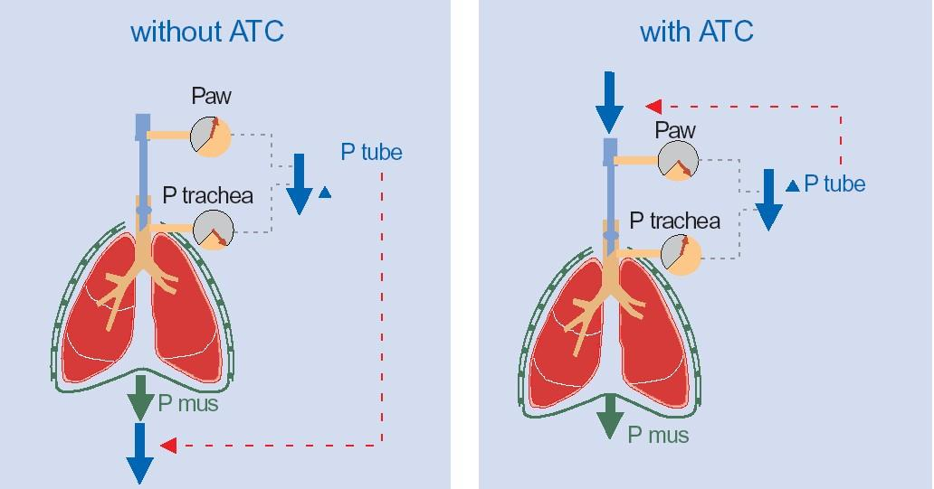 ATC R tubus spontán légzésnél extra WOB kompenzáció