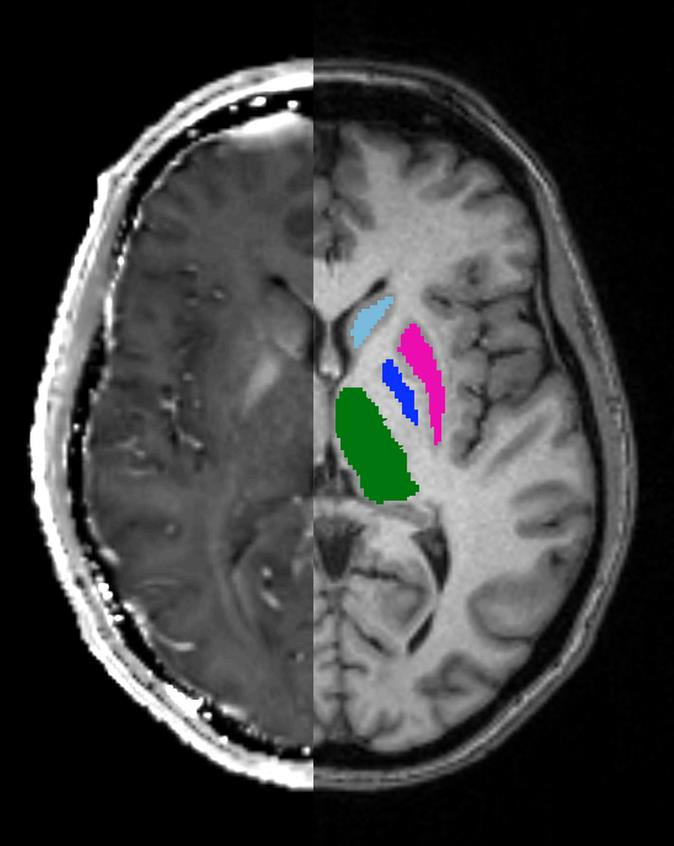 A regionális R2* relaxációs rátákhoz FIRST alkalmazásával négy bilateralis mély szürkeállományi területet (thalamus, nucleus caudatus, putamen és globus pallidus) határoltunk automatikusan körül