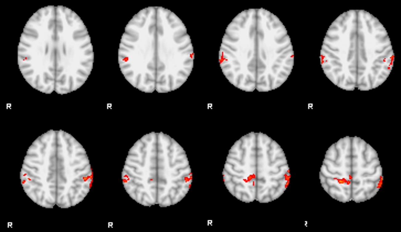 Parkinson-csoport (RD-PD) bal oldali ingerlésekor észlelt wind-up eredményei az egészséges kontrollok bal oldali stimulációval kapott wind-up -jaival összehasonlítva.