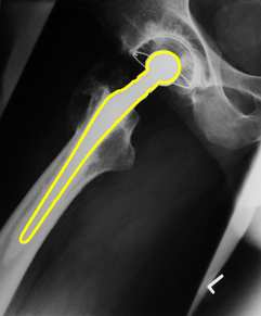 Csíp protézises röntgen képek regisztrációja.