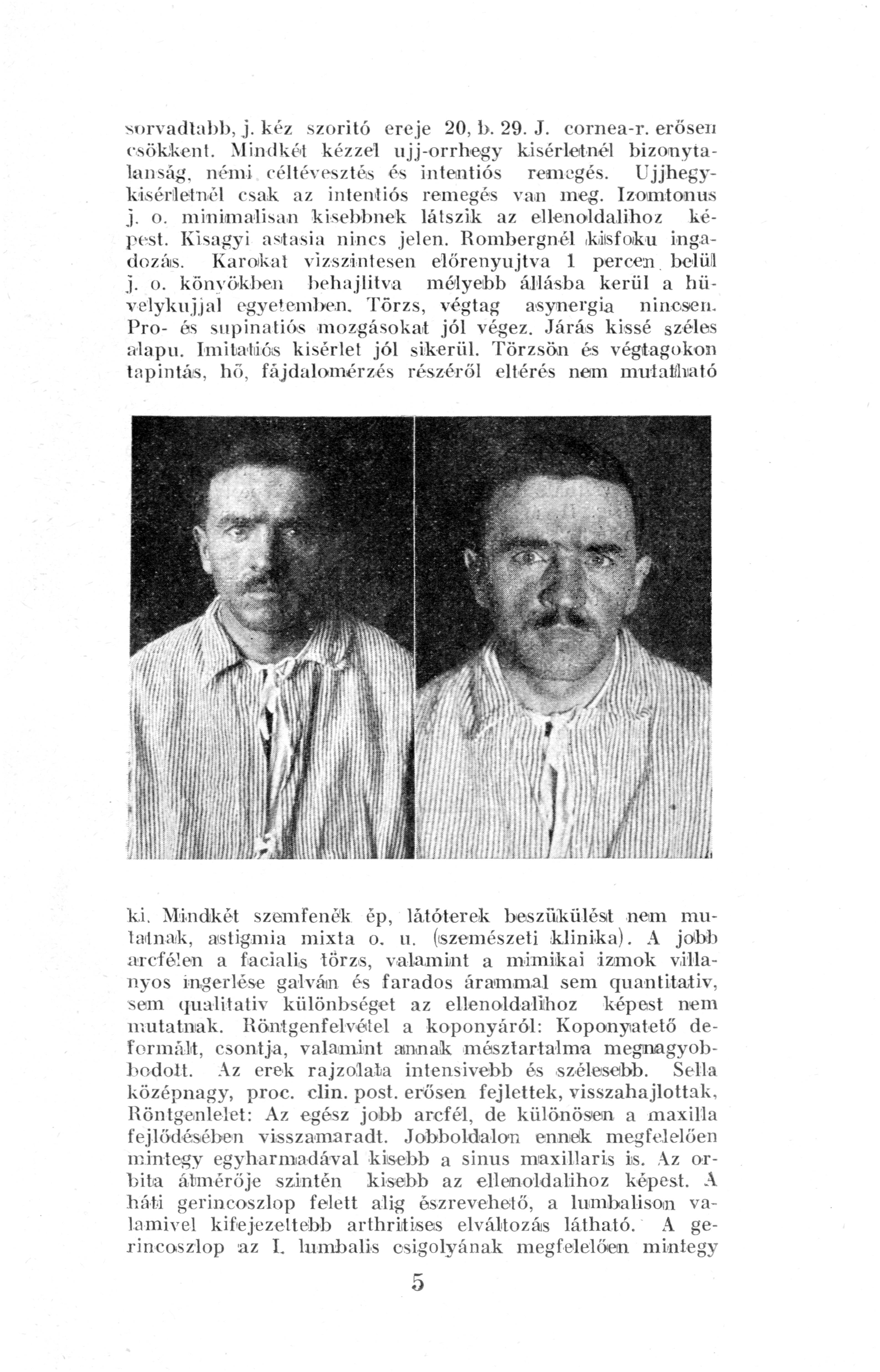 sorvadtabb, j. kéz szorító ereje 20,1>. 29. J. cornea-r. erősen csökkent. Mindkét kézzel ujj-orrhegy kísérletnél bizonyta lanság, némi céltévesztés és intentiós remegés.