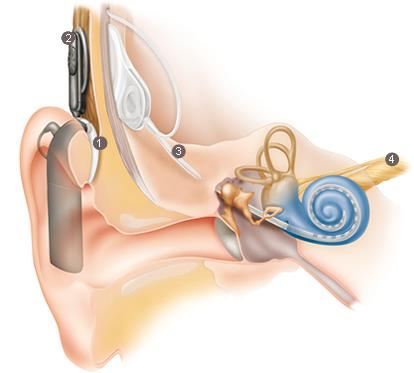 1) beszédprocesszor és mikrofon 2) adótekercs 3) vevő (implantátum) és a hozzá kapcsolódó elektródák 4) hallóideg 3.