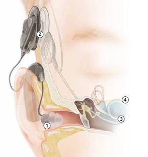Az új generációból a Nucleus 6-ot emelném ki, mivel ez a készülék ötvözi a cochleáris implantátumot és a hallókészüléket (4. ábra).
