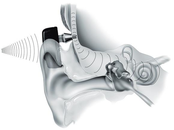 4. ábra: Cochlear Nucleus 6 Az akusztikai egység a hallókészülékhez hasonlóan felerősíti és továbbítja a hangokat.