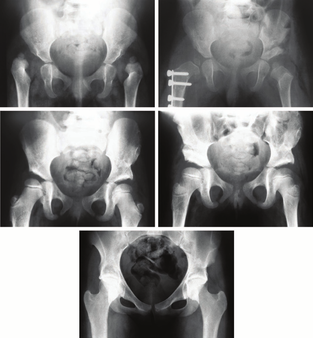 11 hónapos korban történt nyílt repozíció. 11 éves korában a vápa még dysplasiás (jobb felső kép), ezért Pemberton műtét történt (bal alsó kép).
