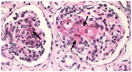 Thrombocyta szám (<150 10 9 /l) Veseelégtelenség: HUS (Gasser-sy) Neurológiai tünetek: TTP (Moschcowitz sy) www.med-ed.virginia.