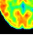 VH-ventral horn, nigra, pars reticulata; SNT- sensory