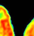 cord; VL-ventrolateral thalamus; VM-ventromedial