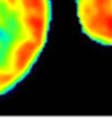 pallidus; VPL-ventroposterolateral thalamus;