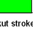 Táblázat Az ischémiás stroke anatómiai helye Az ischémiás stroke