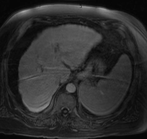 µmol Gd in EOB / kg vs.