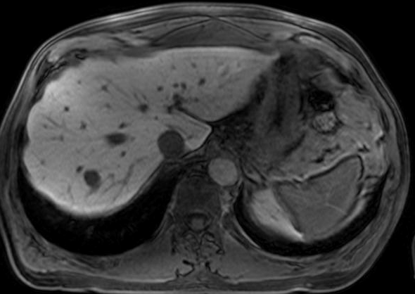 specificus felvétel a hepatocytákban halmozás