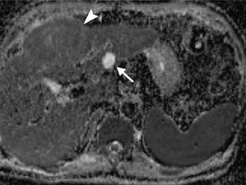 Gourtsoyianni S et al ( (Eur Radiol 2008; 18:486