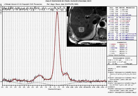 Proton MR spectroscopia a kóros k góc g és s a normál l parenchyma differenciálása -