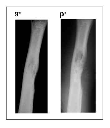 Eredmények Betegünk a COSS (Cooperative Osteosarcoma Study) protokoll alapján 9 hetes neoadjuváns kemoterápiás kezelésben részesült (Semmelweis Egyetem II. sz. Gyermekklinika).