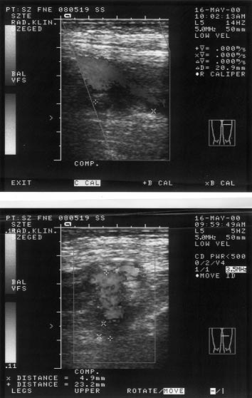 Profilaxis nélkül gyakran alakulhat ki alsó végtagi trombózis, esetleges következményes pulmonalis embolia illetve késõi szövõdményként posztthromboticus szindróma. (7, 8, 9, 15, 21) (1. ábra).