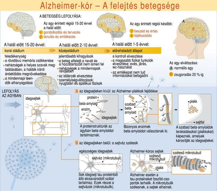 2. Eset Alzheimer kór 2. Eset Alzheimer kór 1.